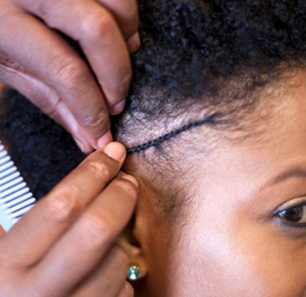 Traction Alopecia and How To Reverse It